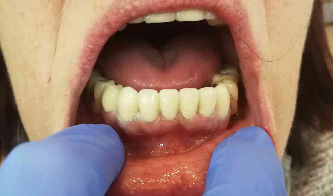 Metal ceramic crowns in combination with metal-based denture -After