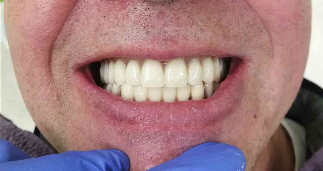 Metal ceramic crowns in combination with metal-based denture-After