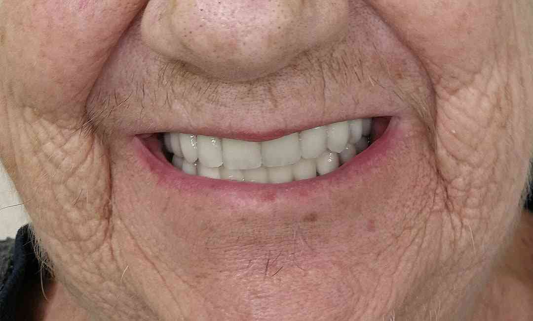 Metal ceramic crowns in combination with metal-based denture-After