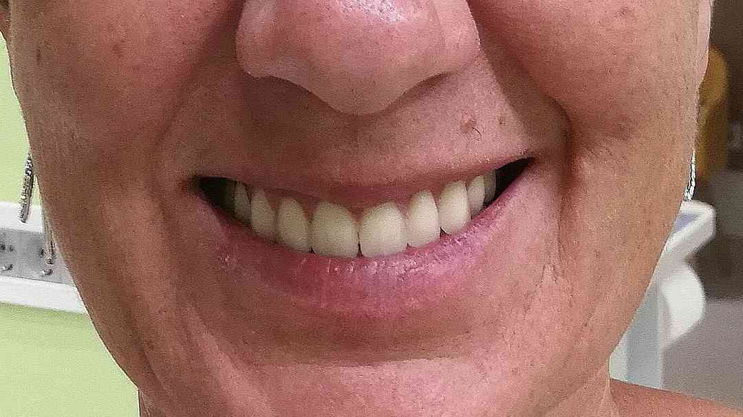 Total acrylic denture T-After