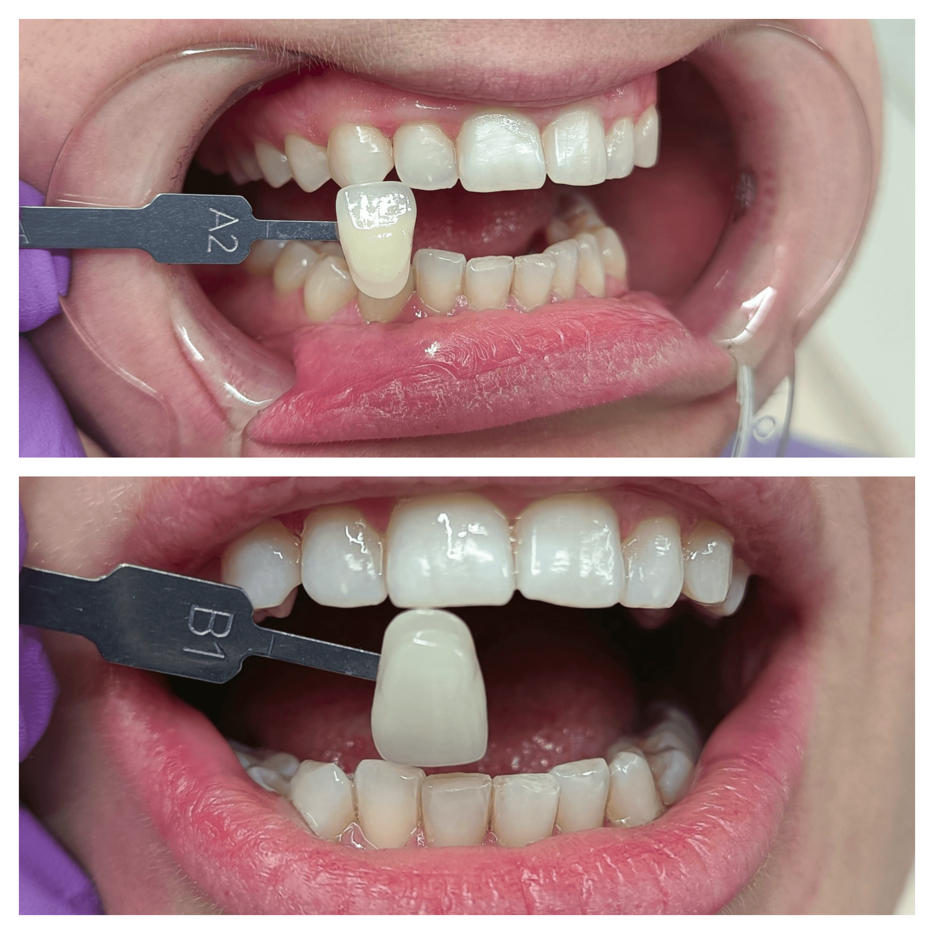 a1 ili b1 boja zuba